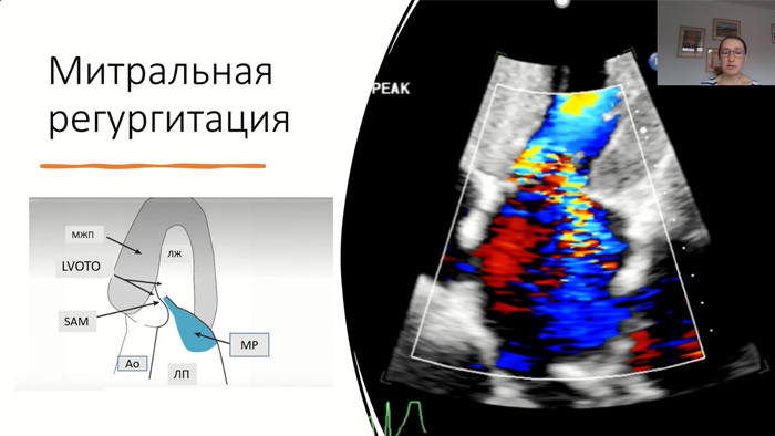 Многообразие фенотипов ГКМП. Эхокардиография и функциональные пробы в диагностике.