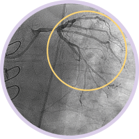 ствол левой коронарной артерии