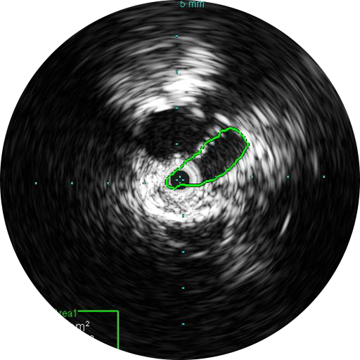 Оценка зон имплантации стентов