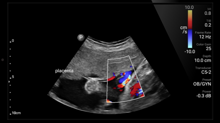 Оценка гестационного возраста плода на ранних сроках беременности с помощью Lumify