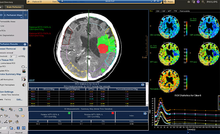 CT Brain Perfusion