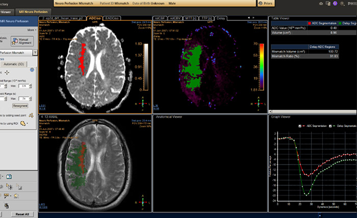 MR T2* Neuro Perfusion