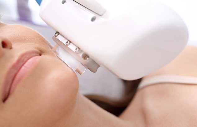 Laser epilation